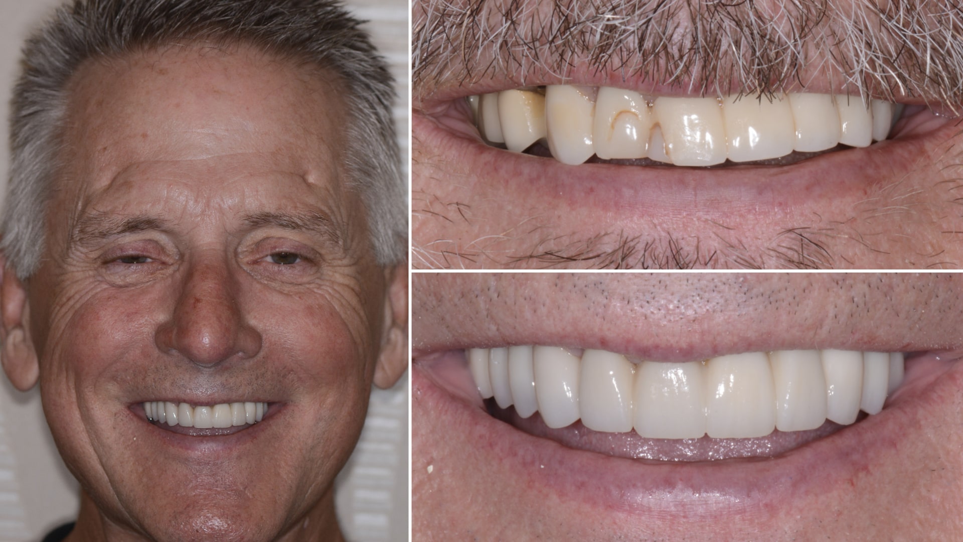 Man's smile before and after dental treatment