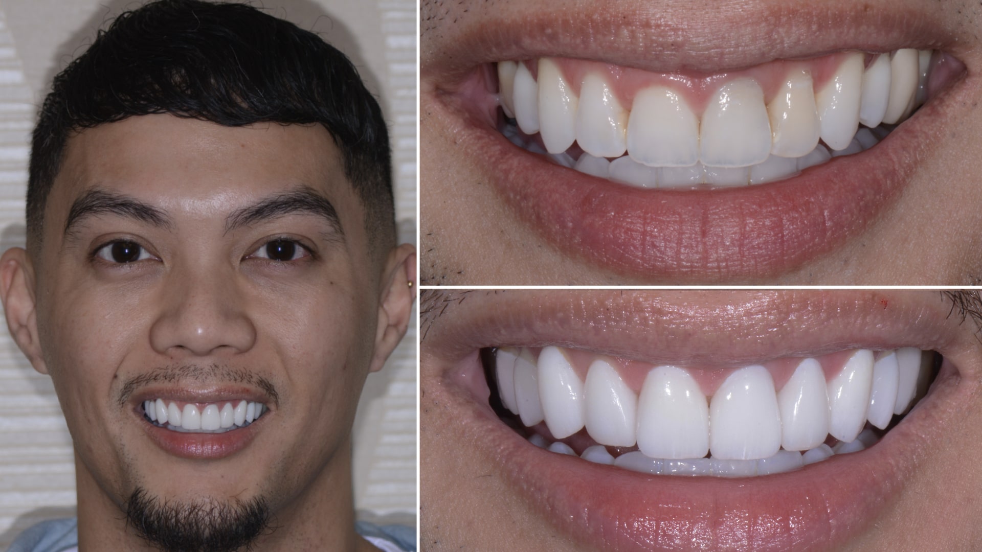 Younger man's smile before and after cosmetic dentistry