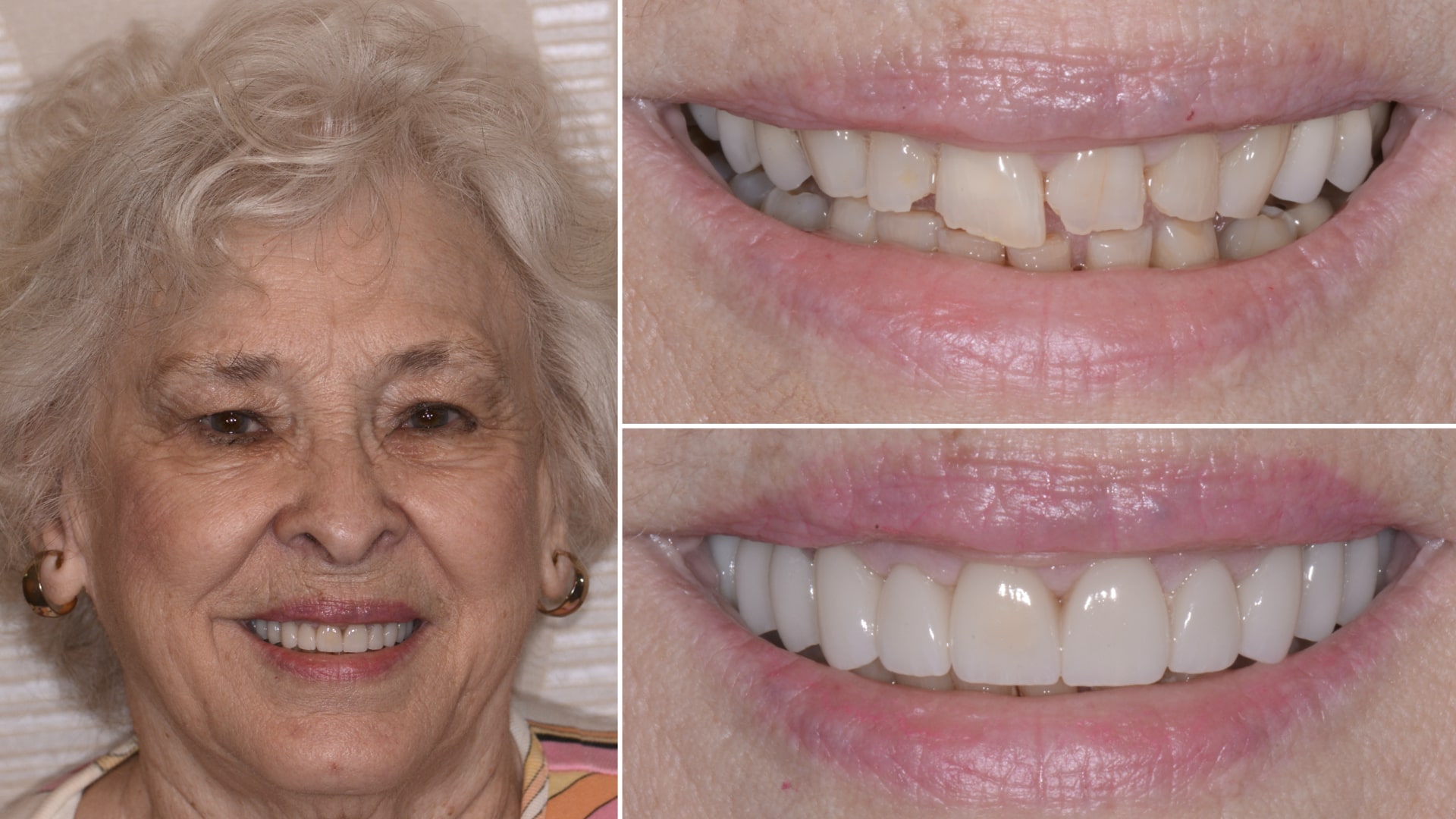 Older woman's smile before and after repairing damaged teeth