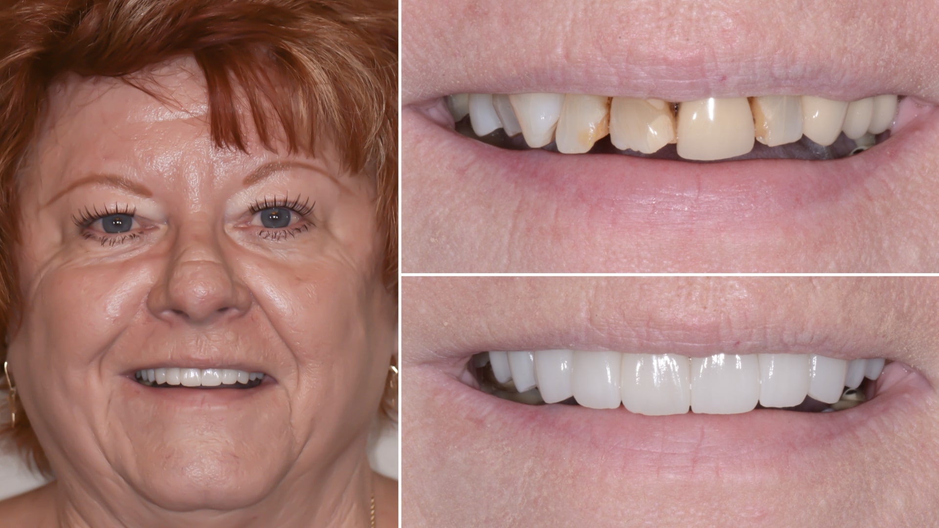 Woman's smile before and after repairing damaged and discolored teeth
