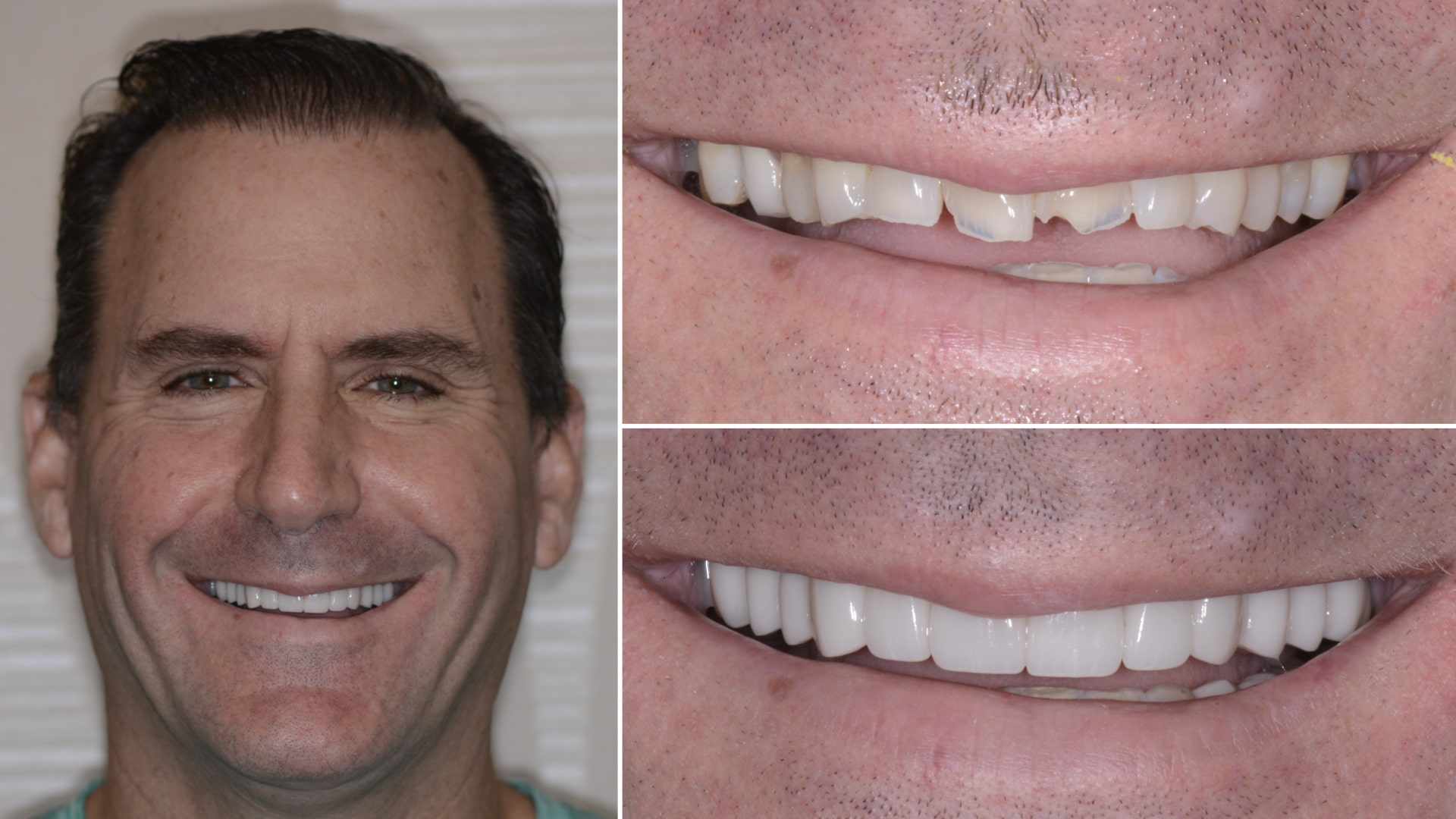 Man's smile before and after repairing damaged top front teeth