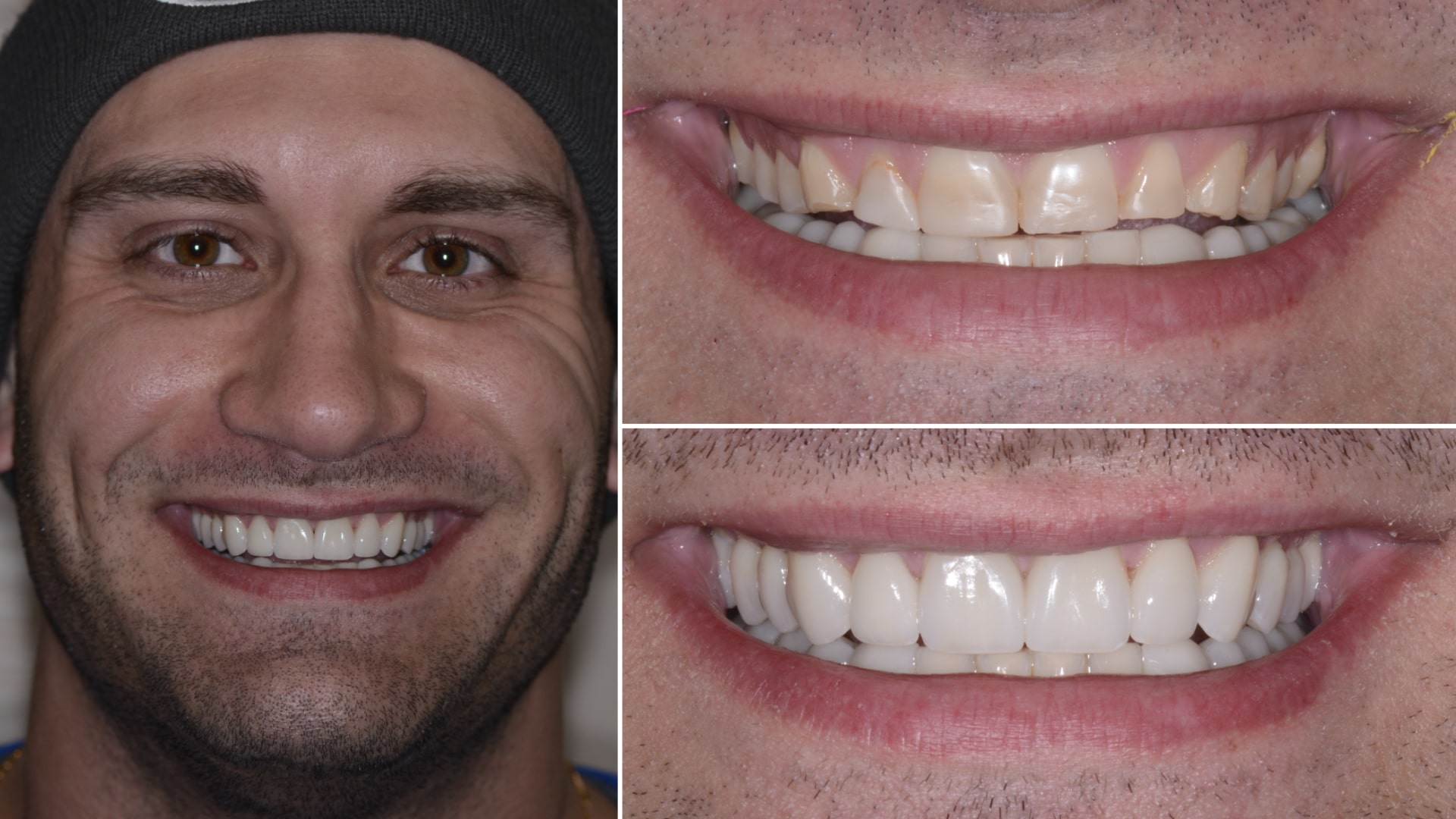 Man's smile before and after addressing short worn teeth