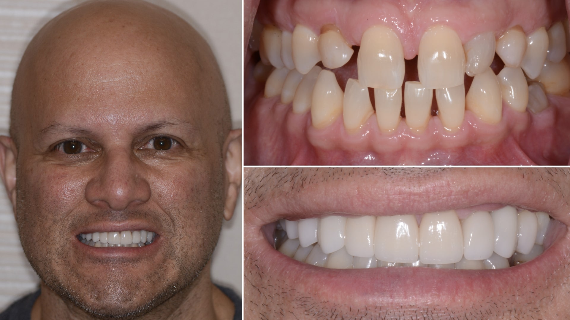 Man's smile before and after treatment to address gaps between teeth