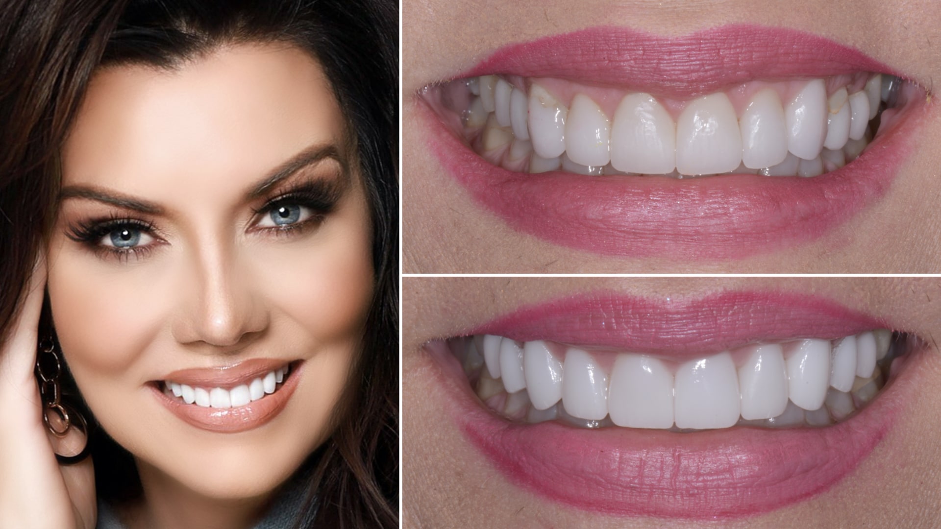 Woman's smile before and after cosmetic dentistry