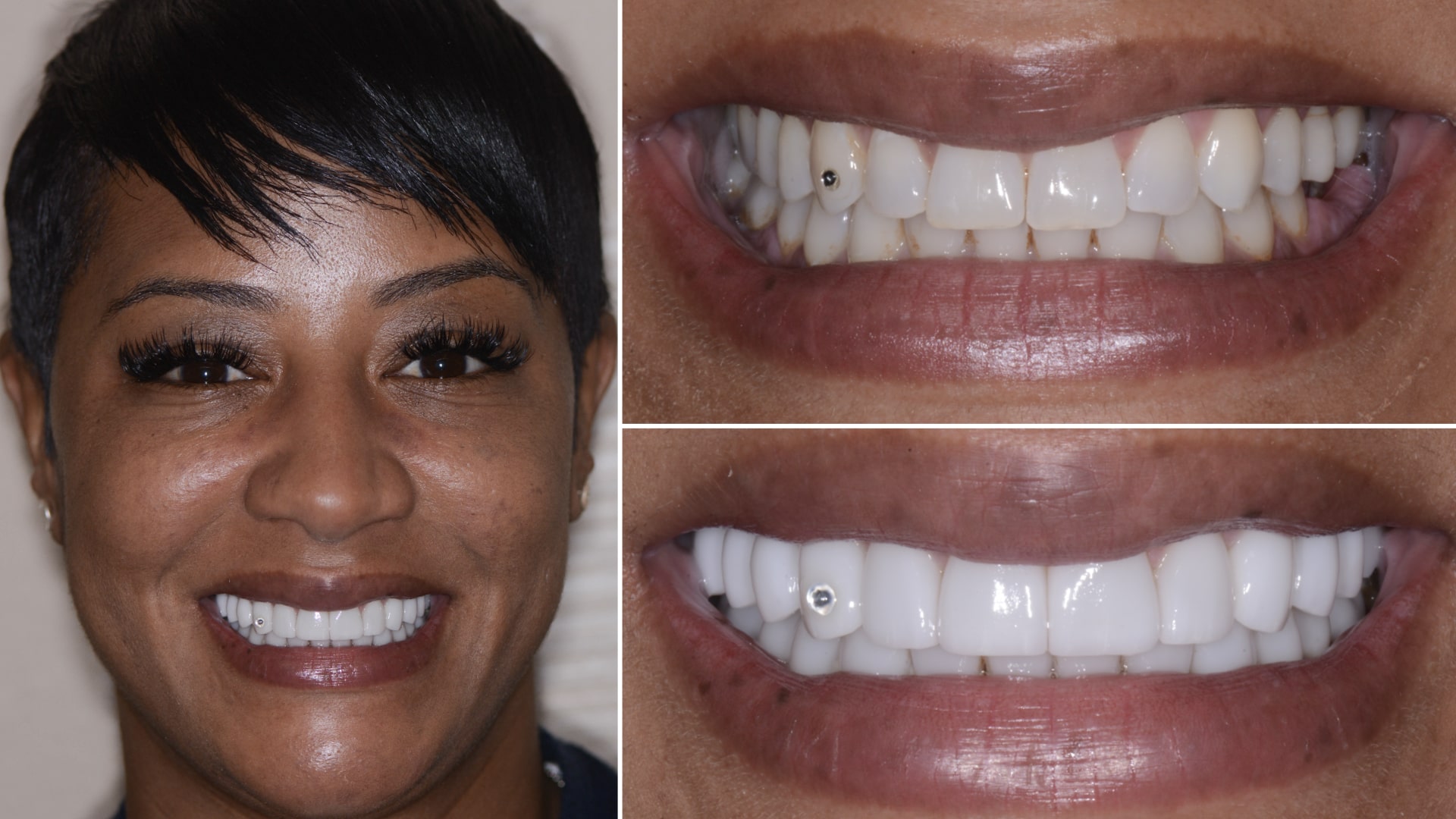 Woman's smile before and after teeth whitening