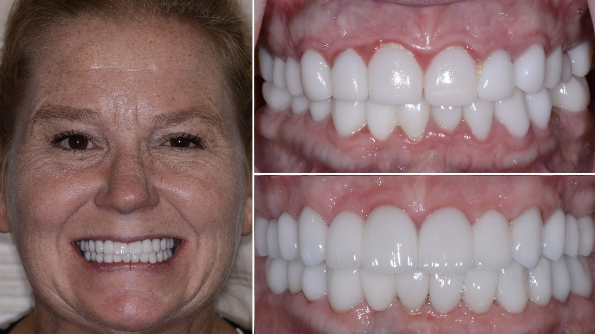Woman's smile before and after treatment to address uneven gum line