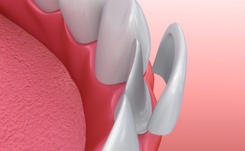 Animated smile during porcelain veneer cosmetic dentistry treatment