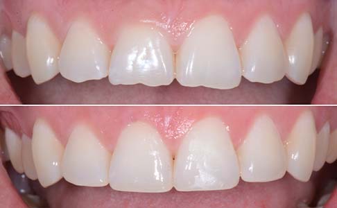 Smile before and after cosmetic dental bonding