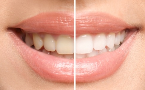 Smile before and after teeth whitening