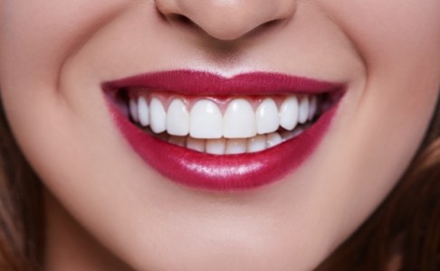 Flawless smile after gum recontouring