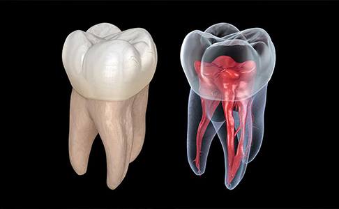 Animated tooth showing inside before root canal therapy