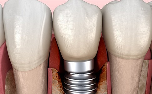 Woman experiencing oral pain due to failed dental implant in Las Vegas, NV