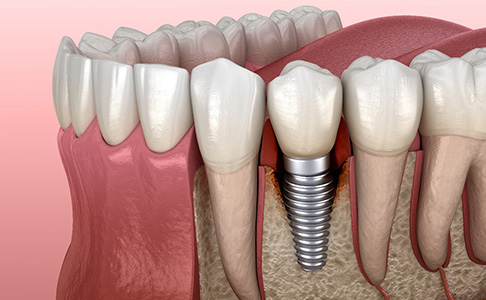 Render of bone loss around a failed dental implant in Las Vegas, NV 