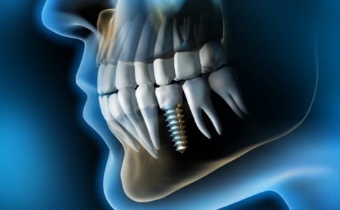 Animated smile with dental implant supported dental crown