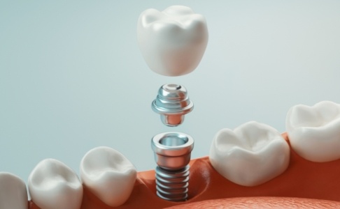 Animated parts of a dental implant supported replacement tooth