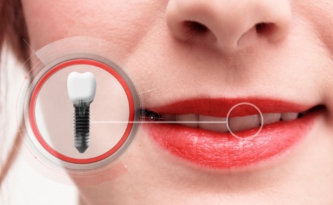Closeup of smile and animated dental implant supported dental crown
