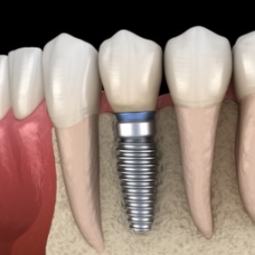 Aniamted smile after dental implant supported dental crown placement