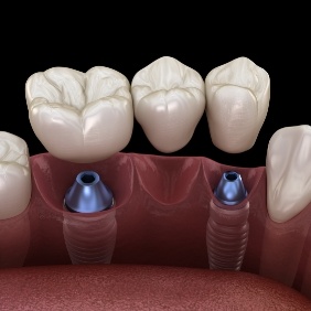 Animated smile during dental implant supported fixed bridge placement