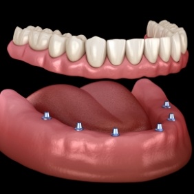 Animated smile during dental implant supported denture placement