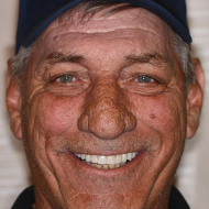 Dental patient smiling after dental treatment