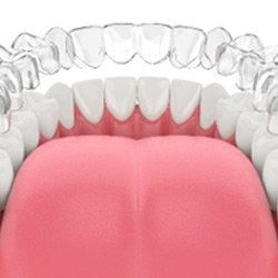 Illustration of Invisalign aligner being placed on bottom teeth