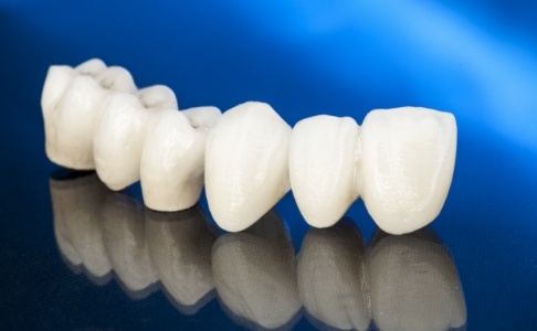 Custom dental bridge to replace missing teeth prior to placement