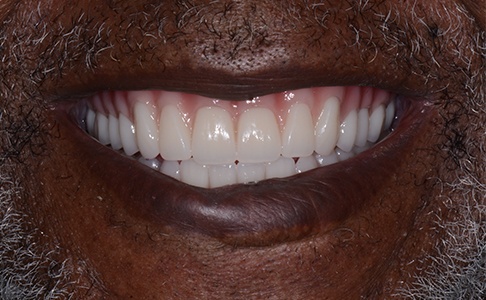 Closeup of smile with denture
