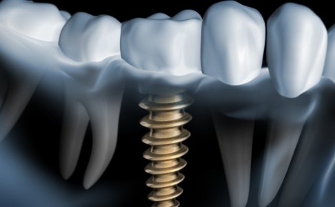 Animated smile with dental implant supported dental crown