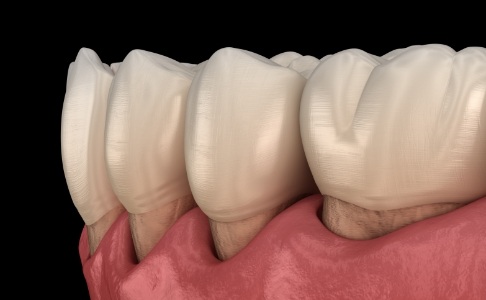 Animated smile with receding gums before periodontal therapy