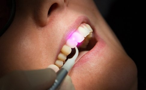 Patient receiving soft tissue laser dentistry treatment