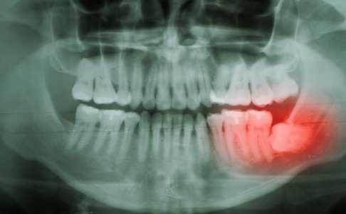X-ray showing impacted wisdom tooth before extraction