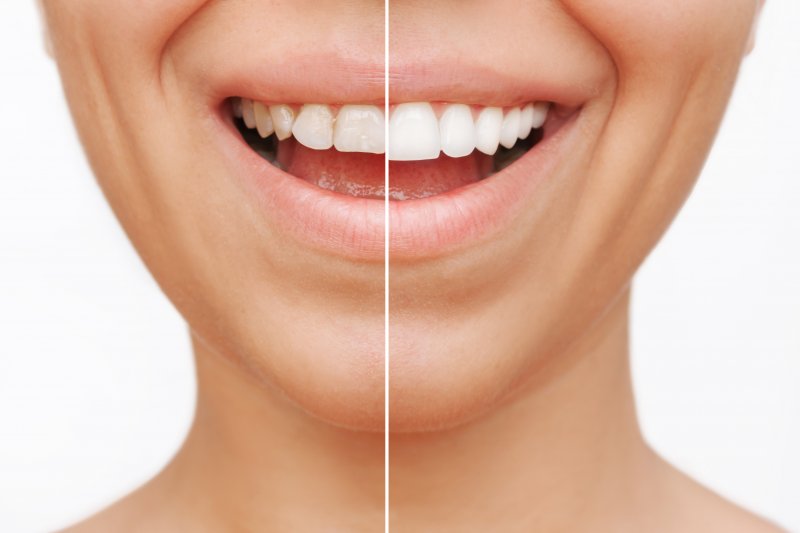 before and after of someone with veneers